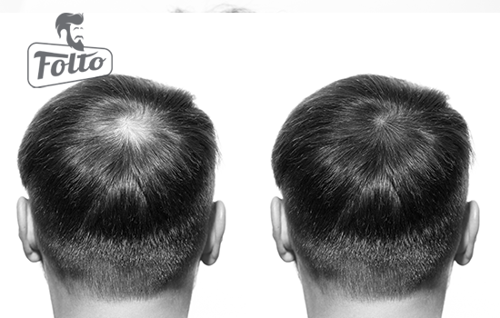 A cosa serve una cura con minoxidil