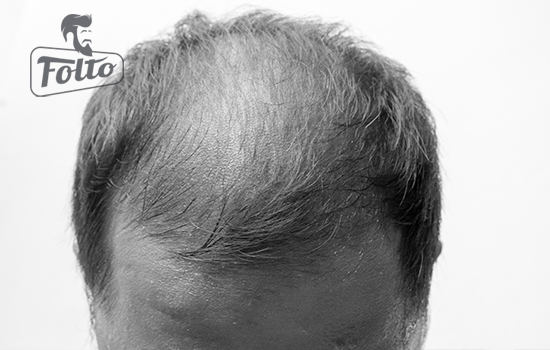 Risultati di cura con minoxidil