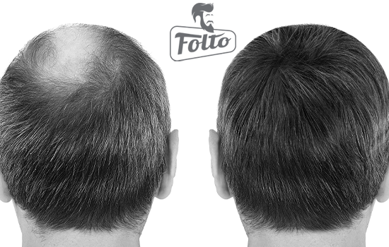 Soluzioni per infoltire i capelli caduti