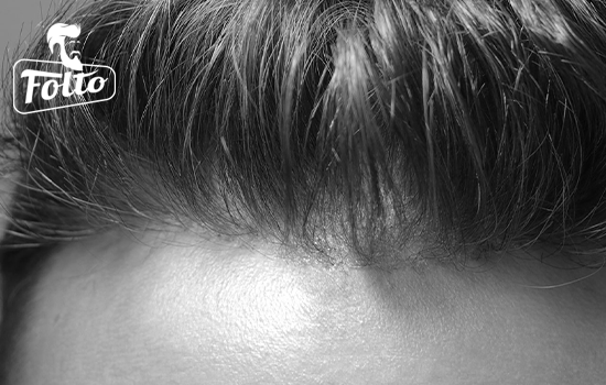 Patch cutanea per l'infoltimento dei capelli