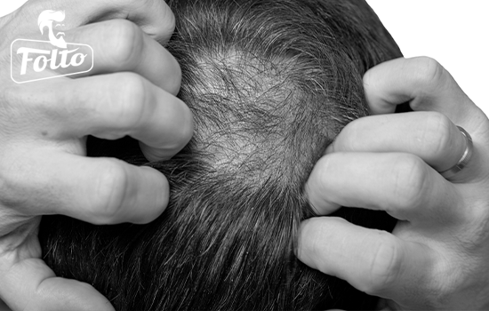 Quali soluzioni esistono per l'infoltimento dei capelli