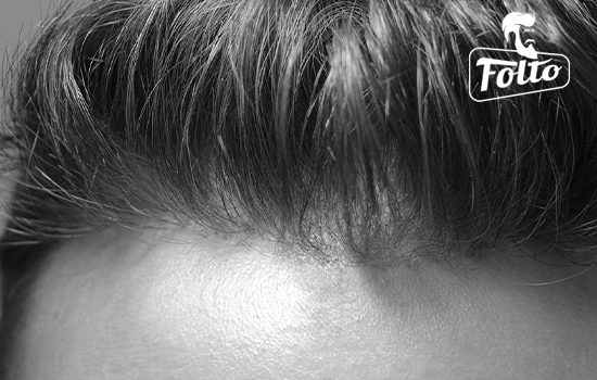 Patch cutanea come soluzione alla caduta dei capelli