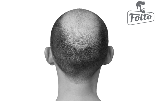 Alopecia androgenetica e caduta dei capelli