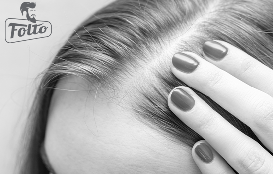 Il minoxidil come cura per l'alopecia femminile 