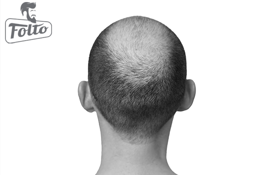 Alopecia androgenetica e caduta dei capelli
