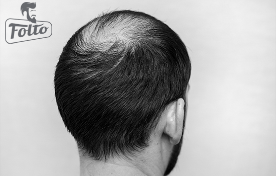 essitono numerosi tipi di alopecia 