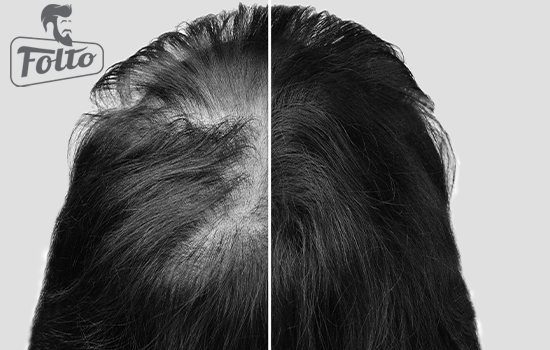 Rallentare il processo di diradamento dovuto all'alopecia androgenetica