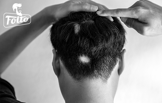 come riconoscere l'alopecia aerata
