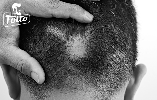 Esempio di alopecia areata