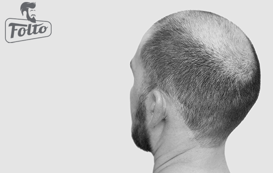 Alopecia e calvizie