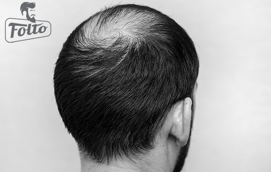 trattamenti efficaci per combattere alopecia androgenetica
